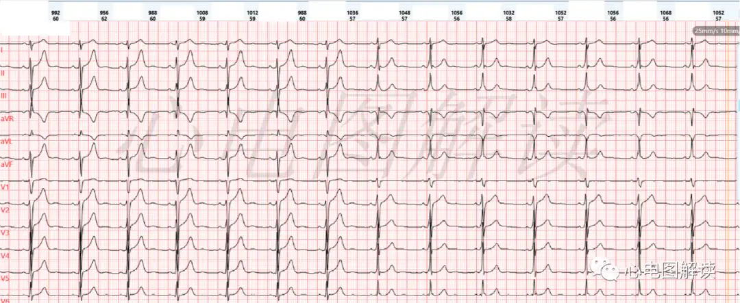 心室预激波 预激综合征 加速是室性自主心律合并等频性房室分离 知乎