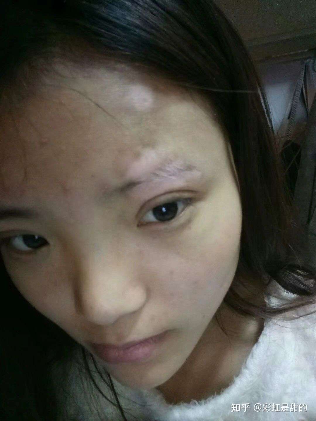 白癜风朋友们永远不要放弃自己好吗 知乎 白癜风朋友们永远不要放弃自己好吗 知乎