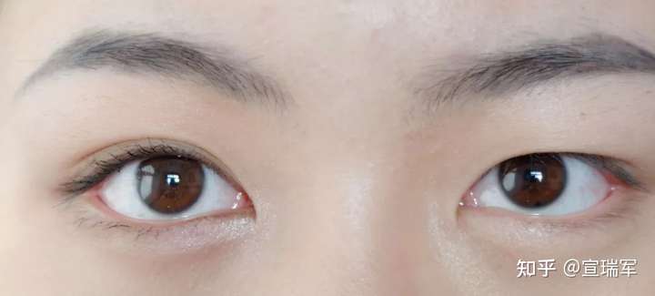 内双有必要割双眼皮吗?