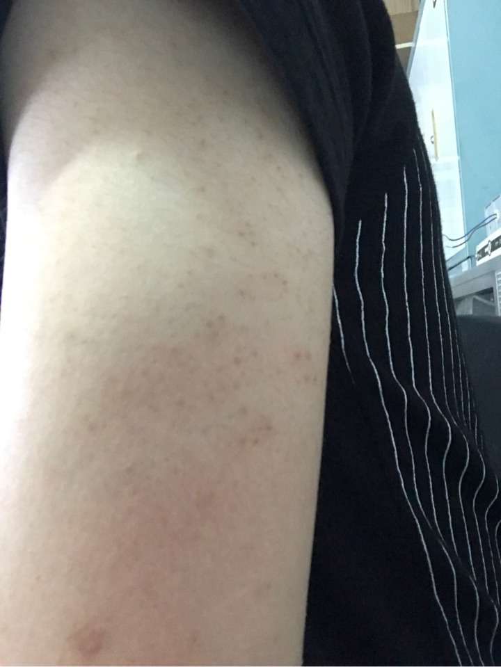 手臂上这些是属于啥 有什么办法消去吗?