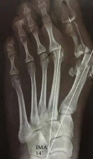 调整足弓,也就是纠正内侧纵弓的塌陷及扁平足导致的足踇外翻.