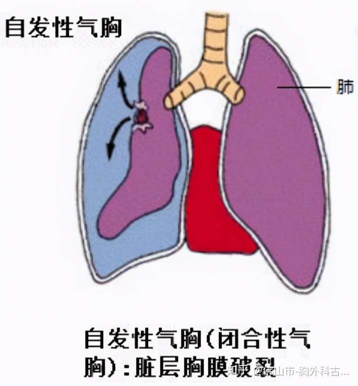 肺真的会气炸吗 知乎