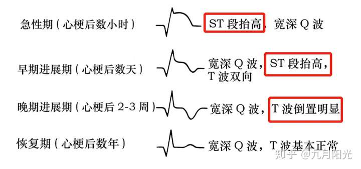 常常看到心電圖報告上這樣寫: st-t改變,t波低平,t波雙向,t波倒置等