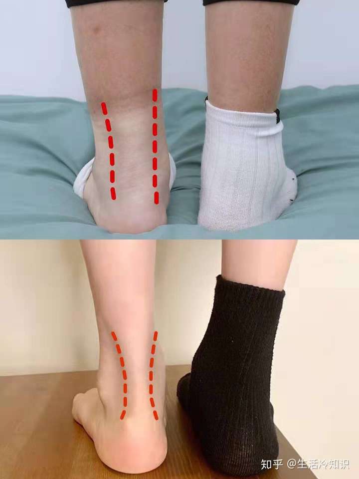 女生脚踝粗是基因决定的吗