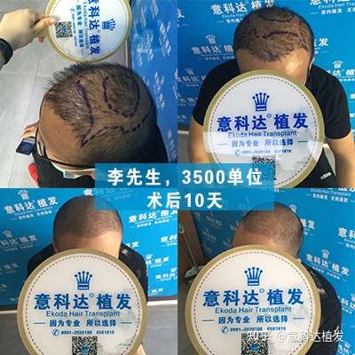 李先生  3500单位  术后10天意科达·植发意科达植发