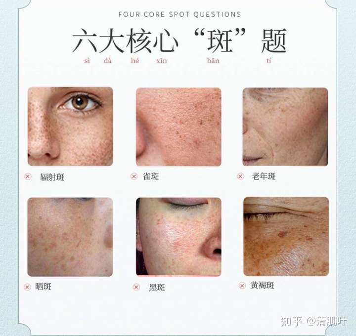 脸上长斑怎么办怎么祛斑