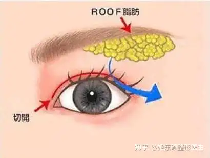 眼部roof脂肪你了解吗