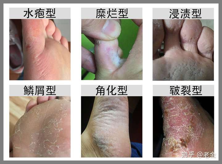香港脚会传染吗图片