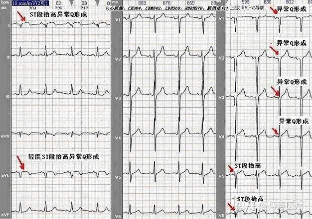 博声医疗异常q波心电图q波异常