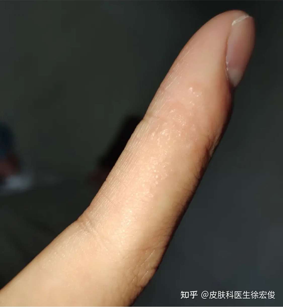 没有得过手上的汗疱疹都不好意思说痒痒是什么感觉