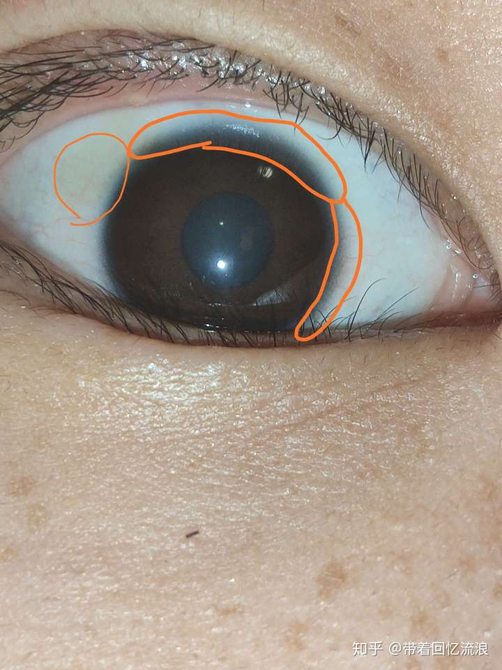 眼外角有点疼照了一下镜子发现眼球有点黄色的而且眼黑上有的地方没有