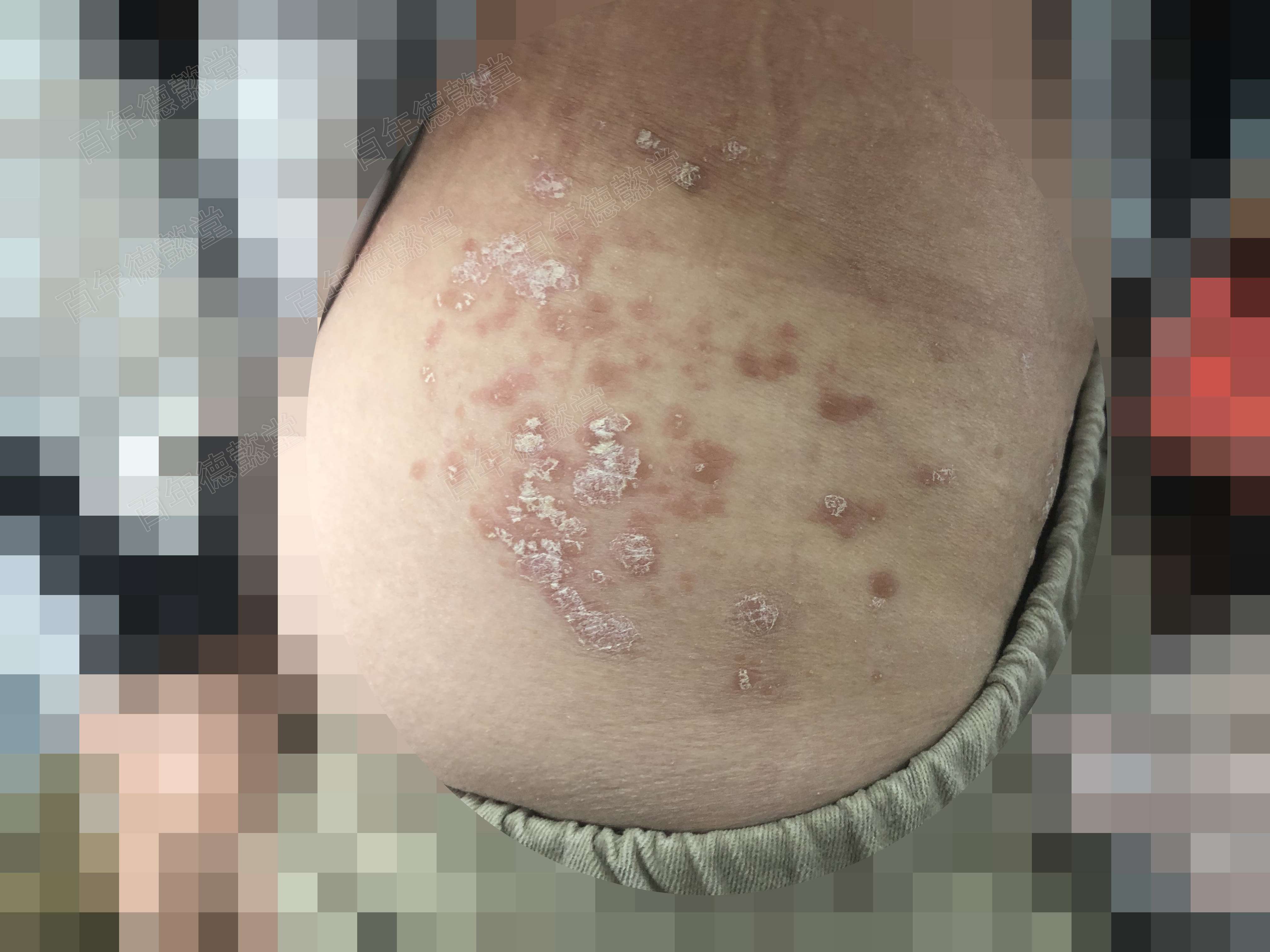 调皮有道李志忠 的想法: 血燥型银屑病,用养血解毒汤: 【处方组