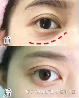 30岁变成20岁的眼部穴位按摩法丨三十岁变双眼皮正常么