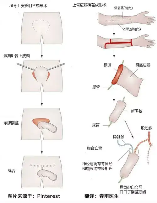 女变男手术时的 那活儿 是怎么无中生有的 知乎