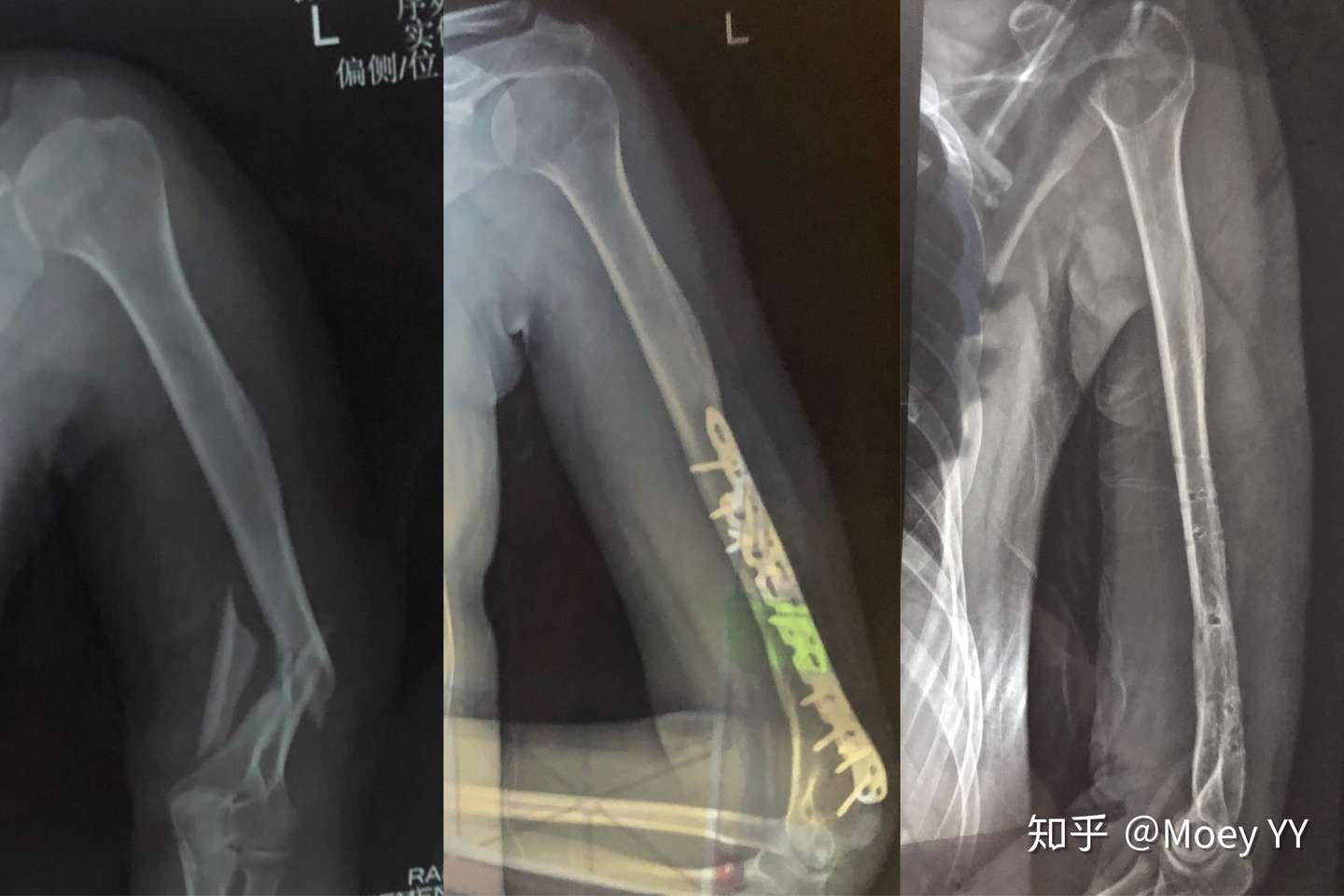 肱骨骨折桡神经损伤康复及取钢板经历分享 知乎