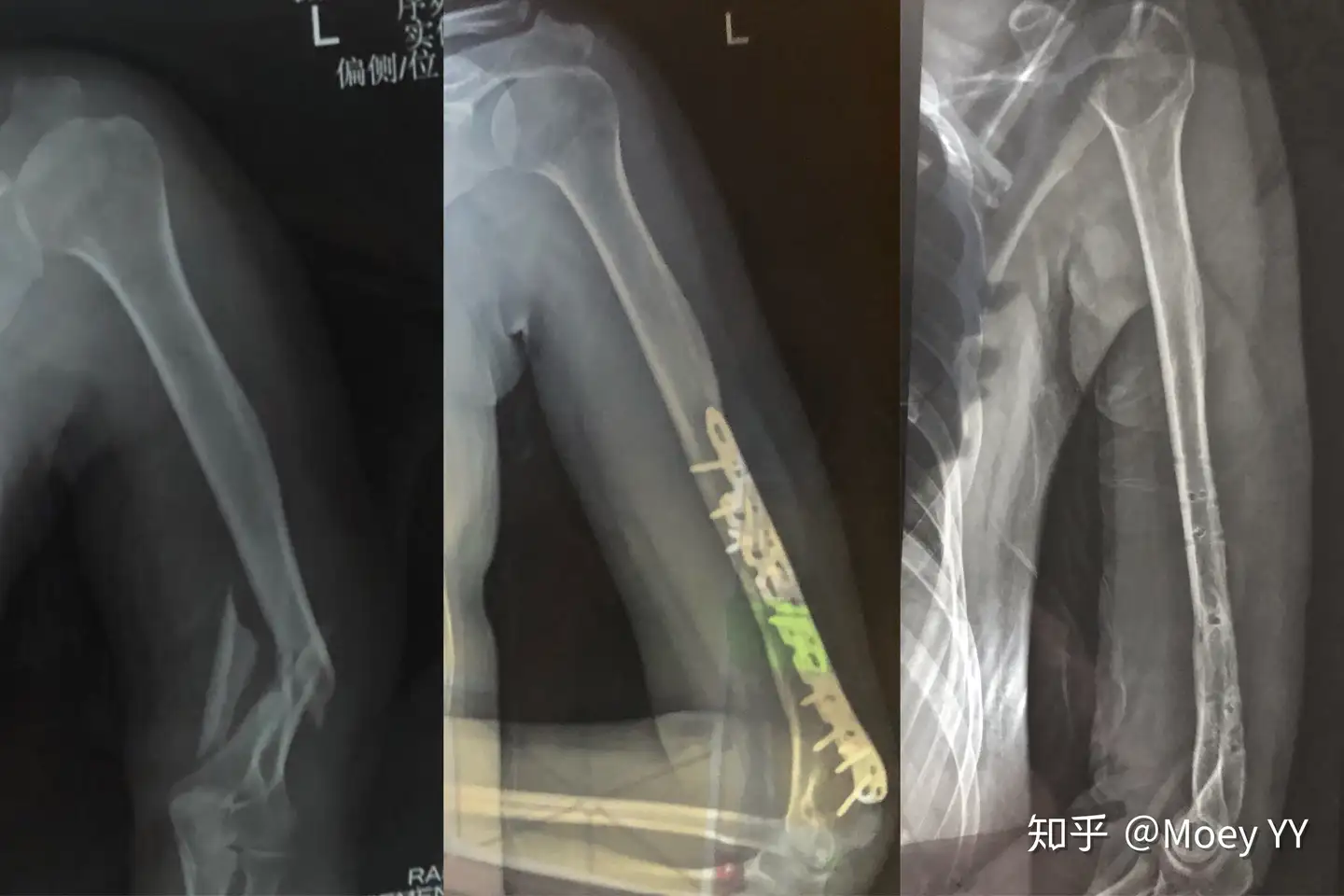 肱骨骨折桡神经损伤康复及取钢板经历分享 知乎