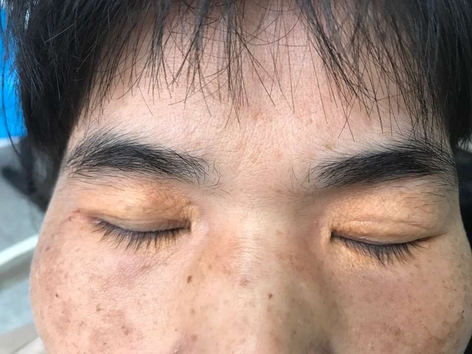 睑黄瘤,部分人跟血脂升高有关,有些人没有关系,可以去医院做co2激光