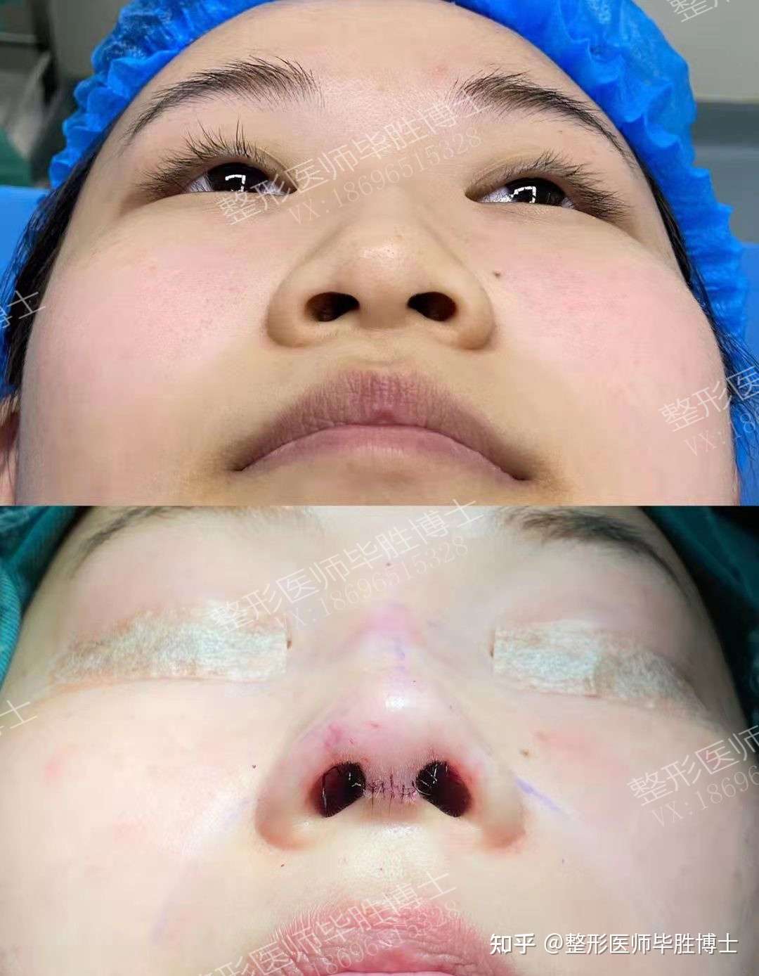 术后案例膨体半肋鼻综合术后即刻