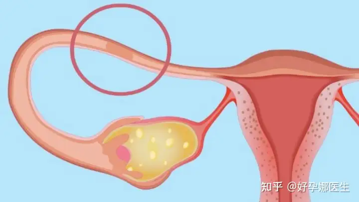 成都哪家医院供卵（试管婴儿真的比人工授精好吗？）