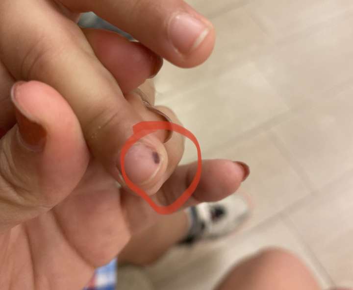 儿子手指甲盖上这个黑点是什么