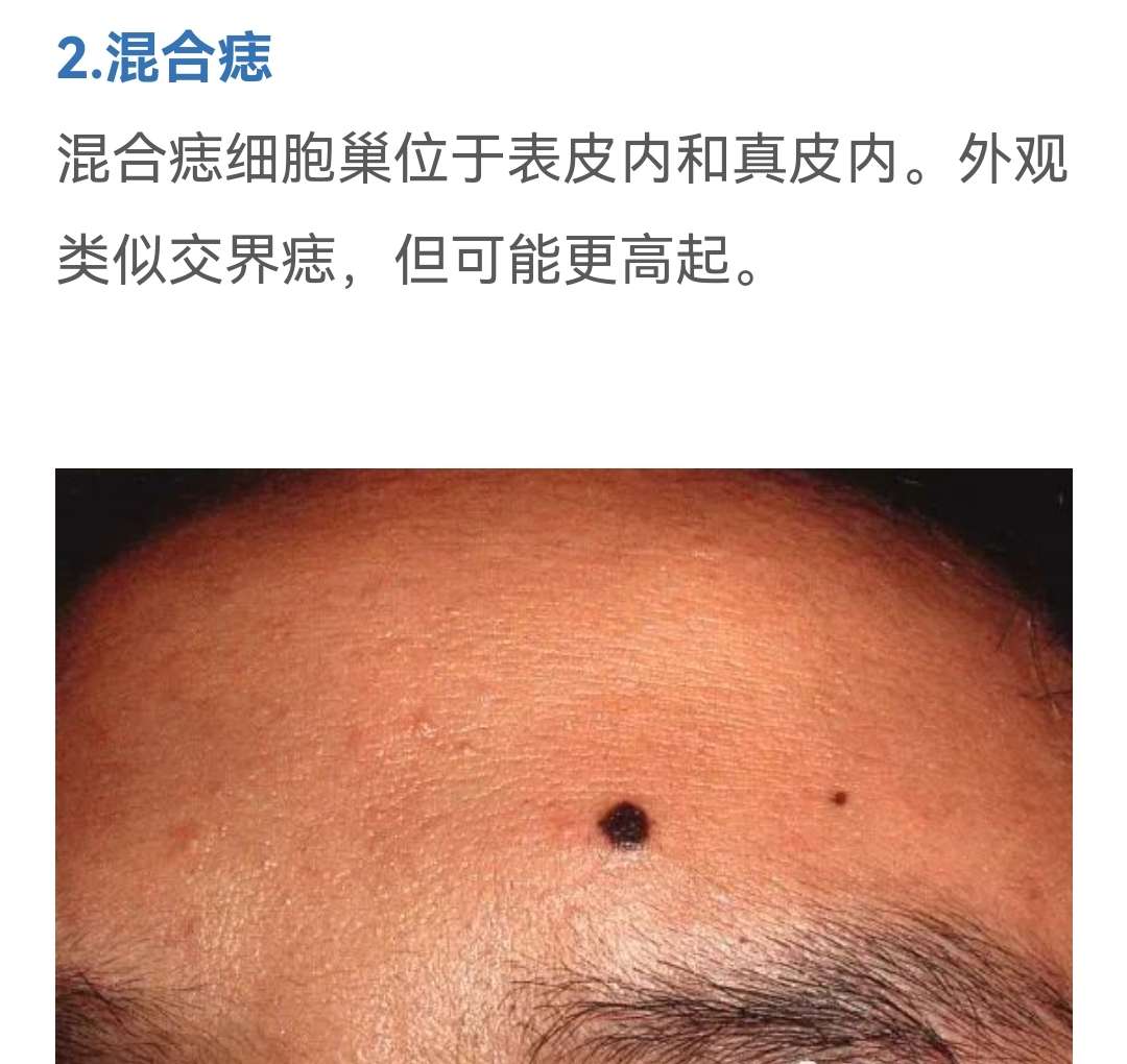 卉卉圆 的想法: 痣的分类: 1交界痣 2混合痣 3皮内痣 - 知乎