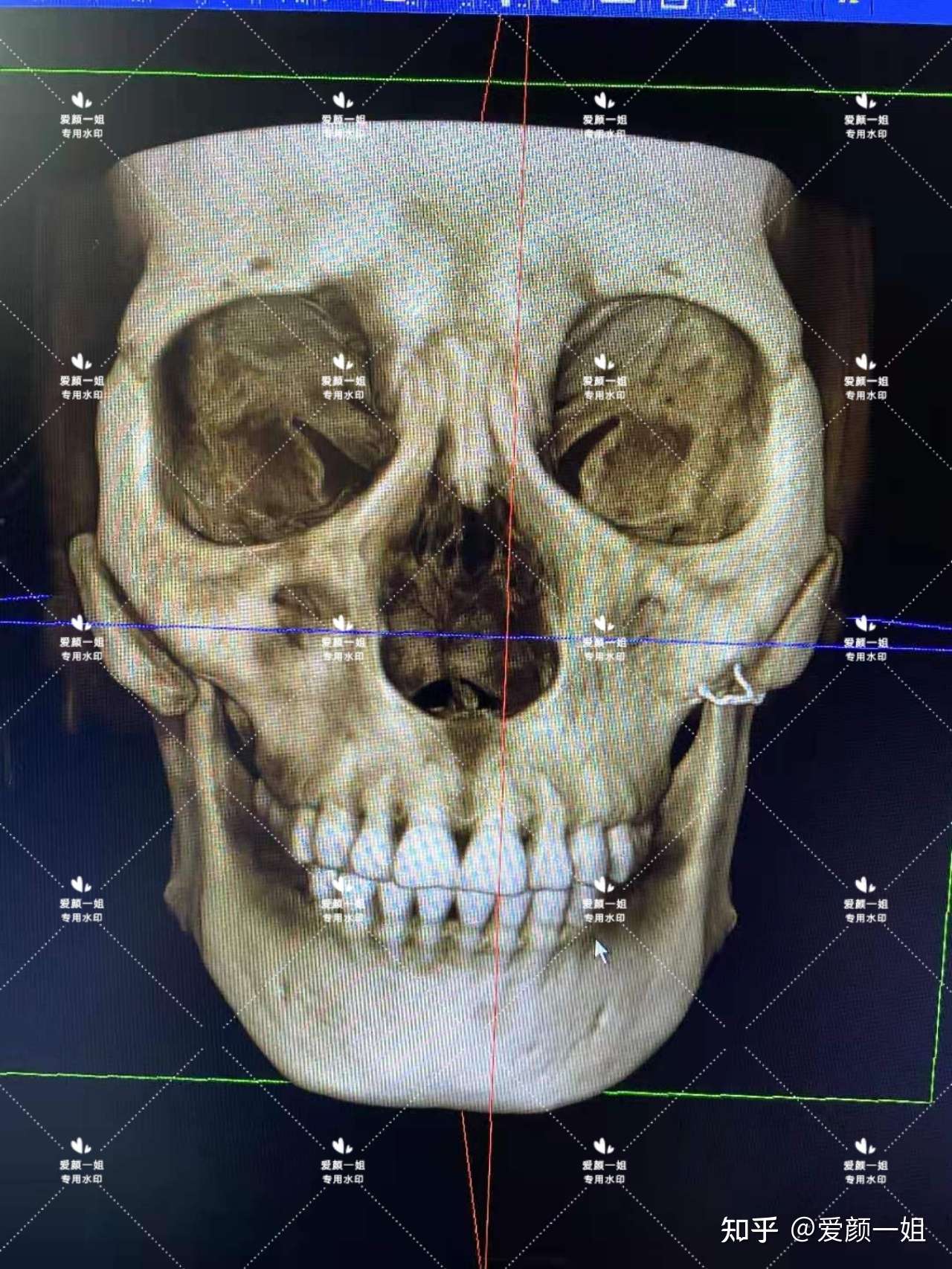 轮廓颧骨篇 颧骨颧弓内推失败 知乎