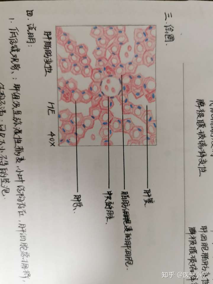 慢性肝淤血绘图图片