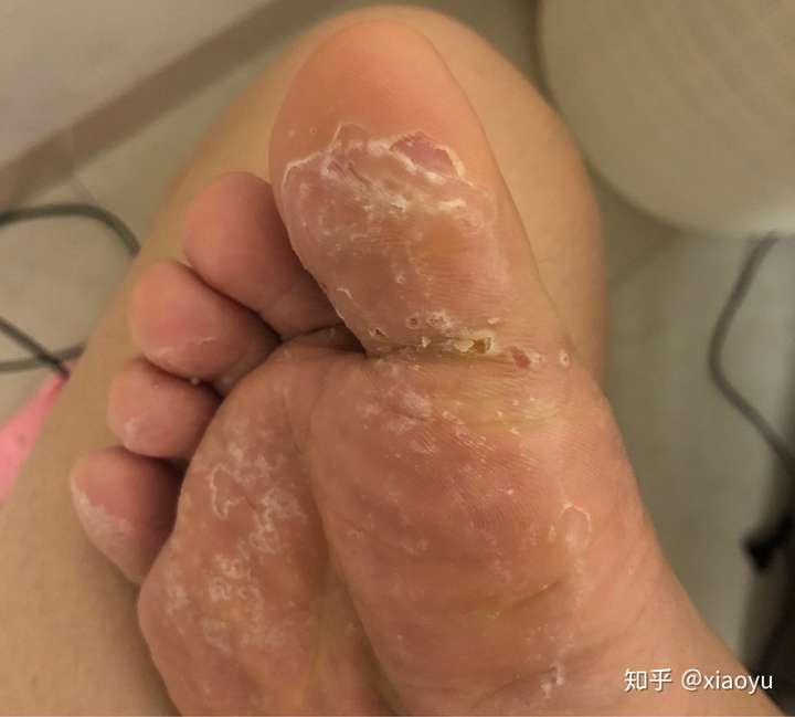 糜烂性水疱型脚气治愈