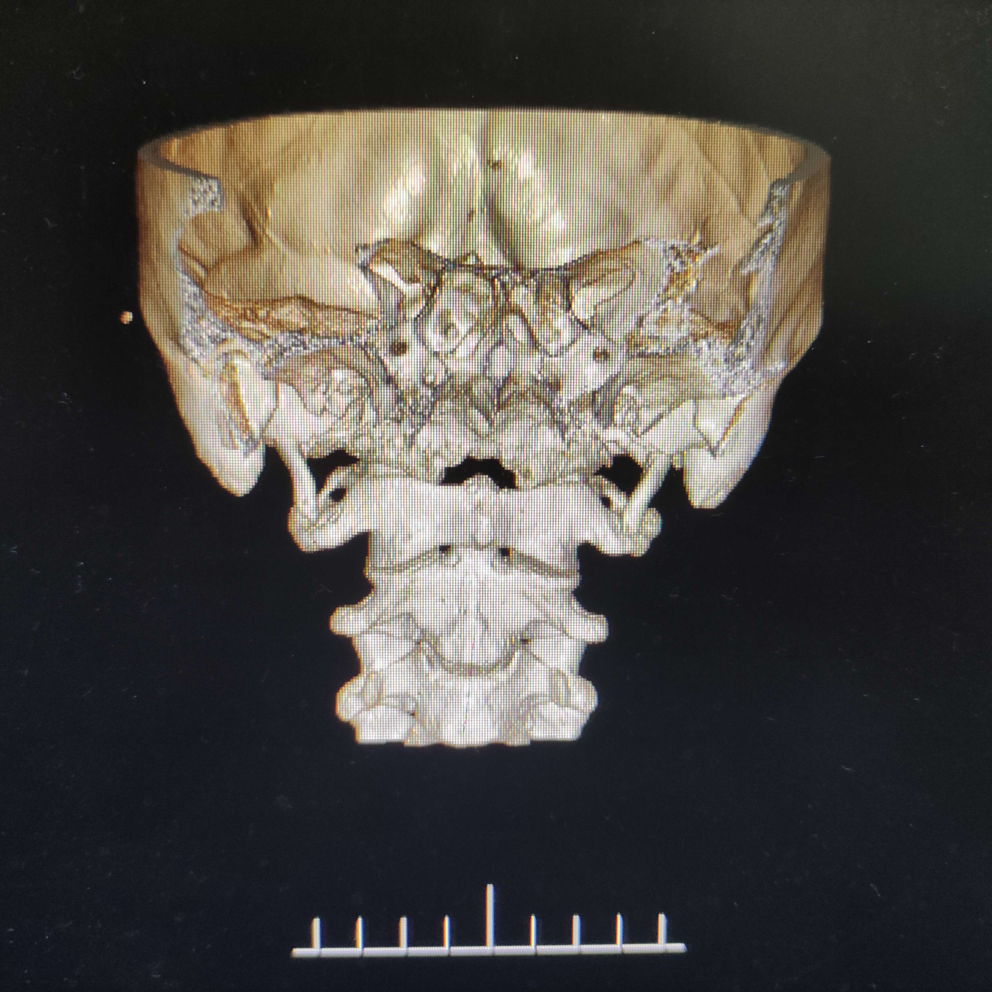 没想出几个常用的特殊摄影技术,像冈上肌出口位,茎突正侧位,鼻咽侧位