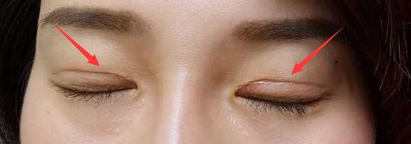 双眼皮手术四个月了,看上去特别不自然,是不是手术失败了,需要修复吗?