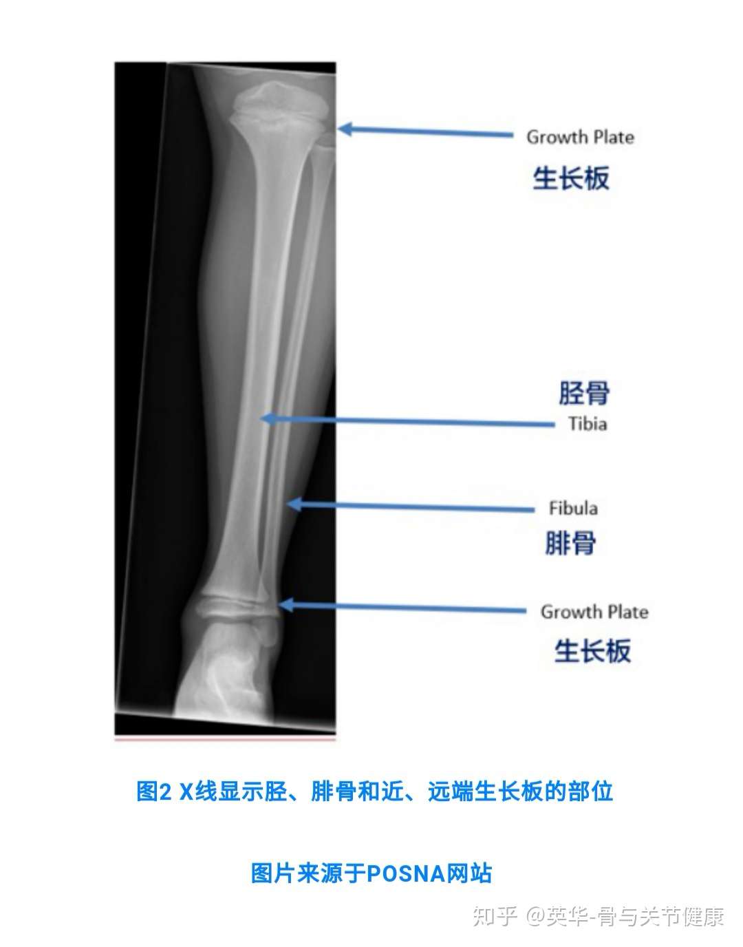 胫骨骨折tibial Shaft Fractures 知乎