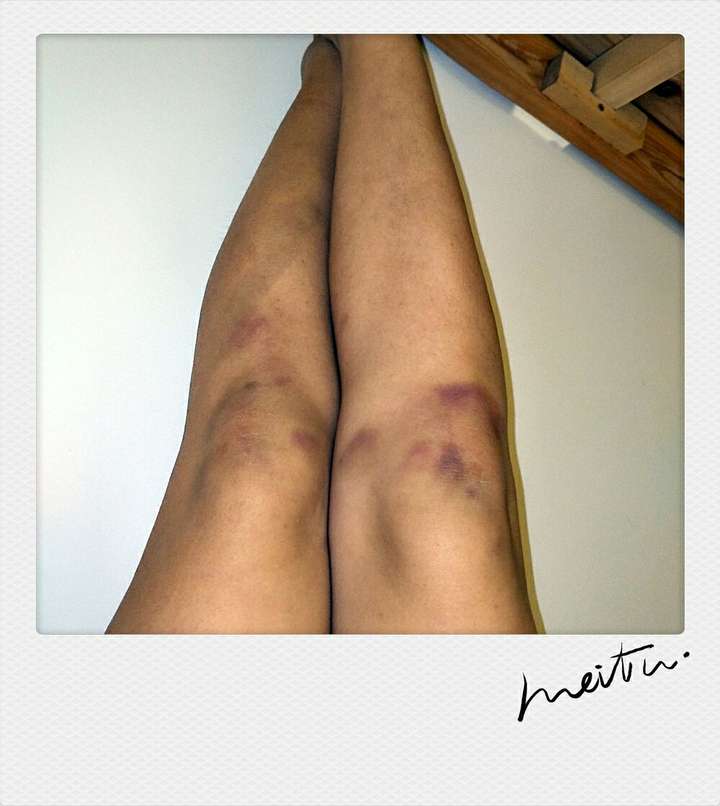 舞蹈生膝盖受伤图片图片