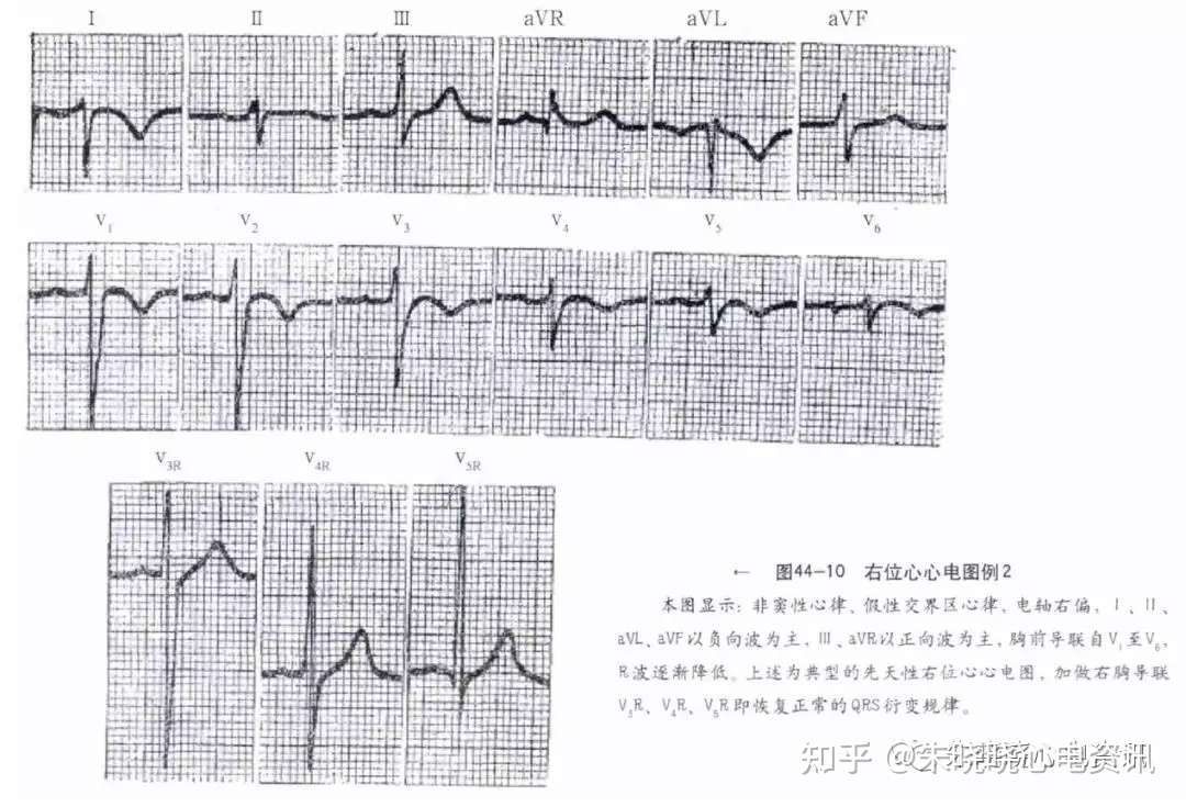 临床实用心电图入门第四讲 心率 心电轴与心电图伪差 知乎