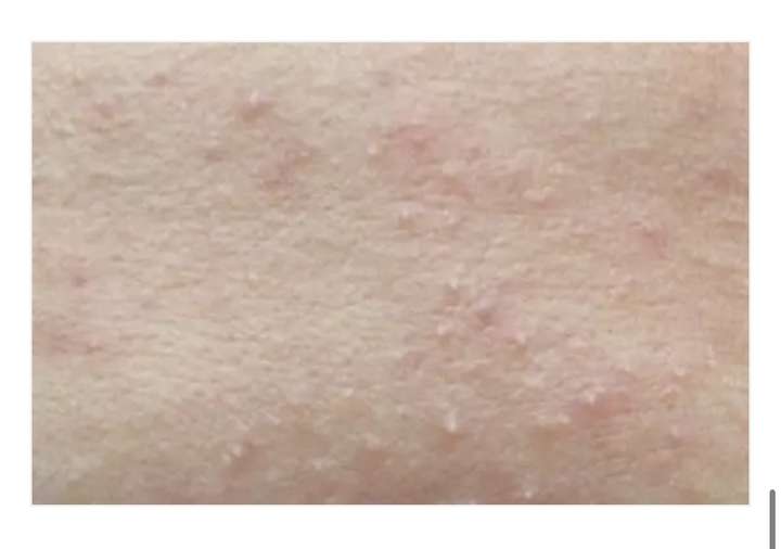 大家用过的最好用的去黑头产品是哪款?