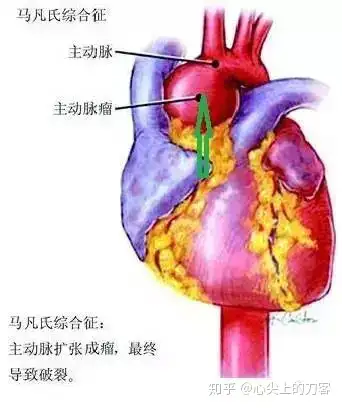 一家族7人确诊马凡氏综合征（马凡氏综合症致病基因） 第4张