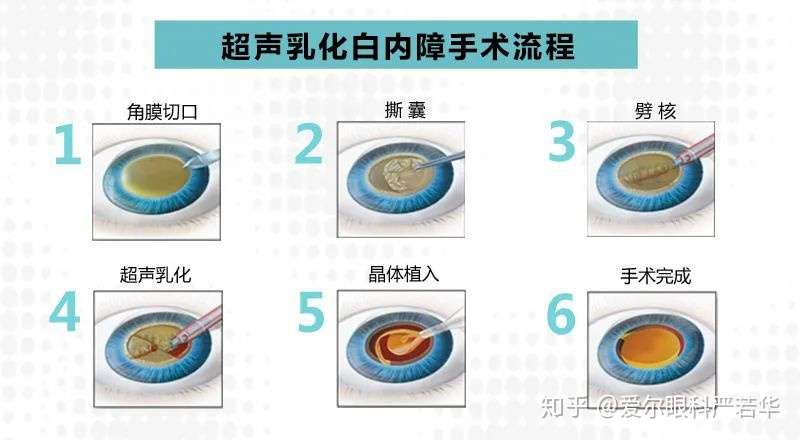 白内障手术及术前术后注意事项详解 知乎