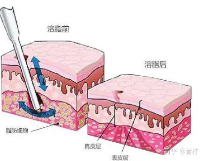 溶脂针副作用 溶脂针的危害有哪些 别不当回事