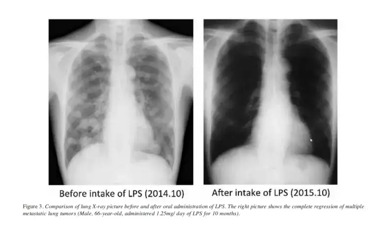 神奇的物质lps 被誉为21世纪医学奖最伟大的发现 知乎