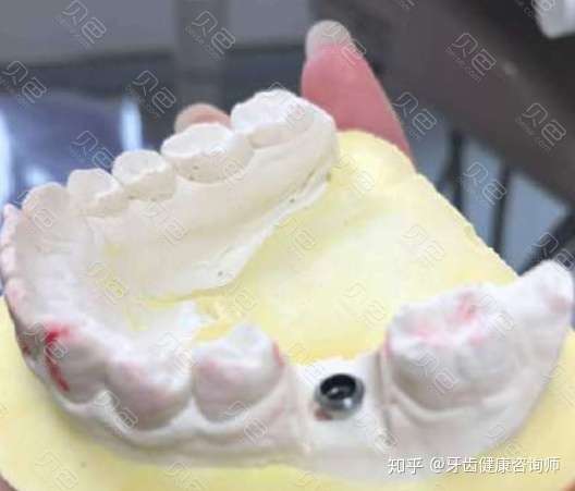 种植牙过来人告诉你6500一颗韩国登腾的种植牙性价比到底怎么样