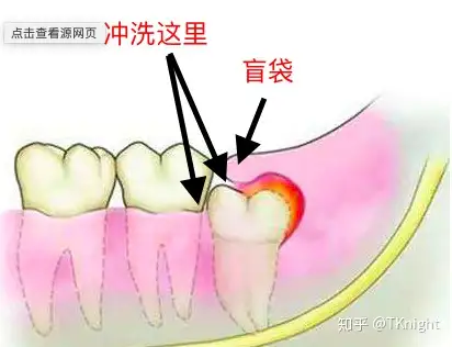 在美国得了智齿冠周炎怎么办