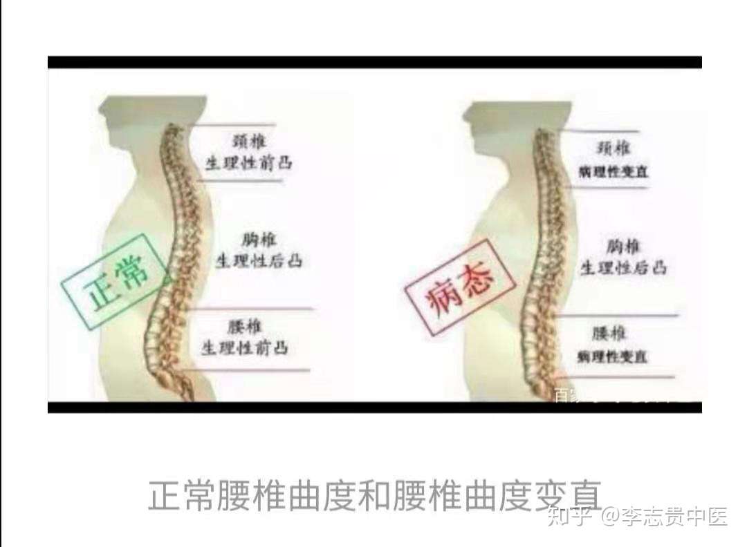 正骨专家李医生告诉您 腰椎生理曲度变直究竟是怎么回事 知乎