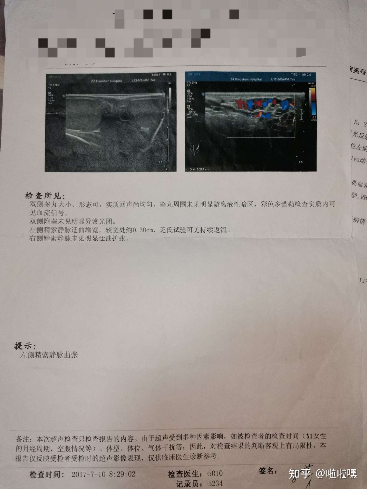 来聊聊我近几年的精索静脉曲张历程 知乎