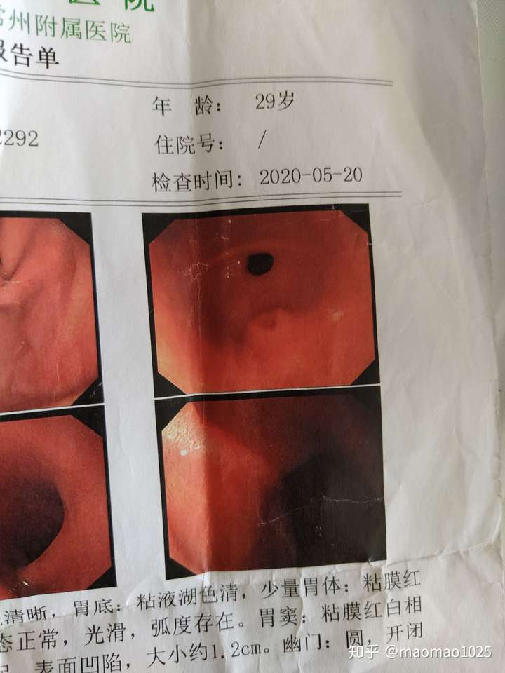 异位胰腺普通胃镜看到的是什么样子的