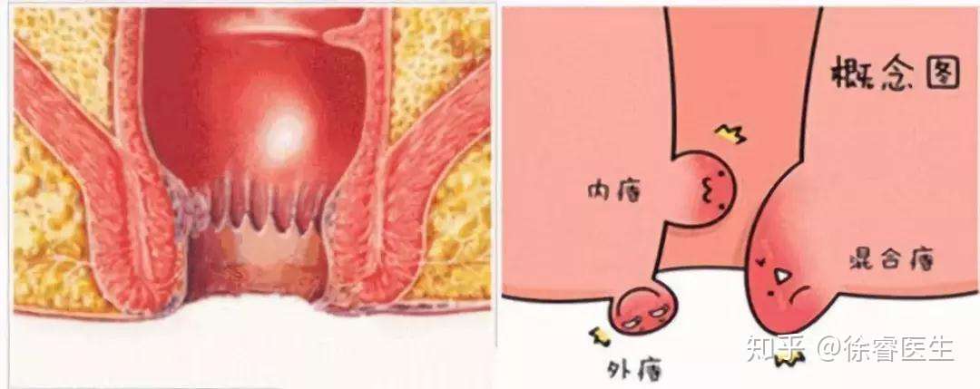 痔疮有3型4期，快来对照下，你是哪一型，哪一期？ - 知乎