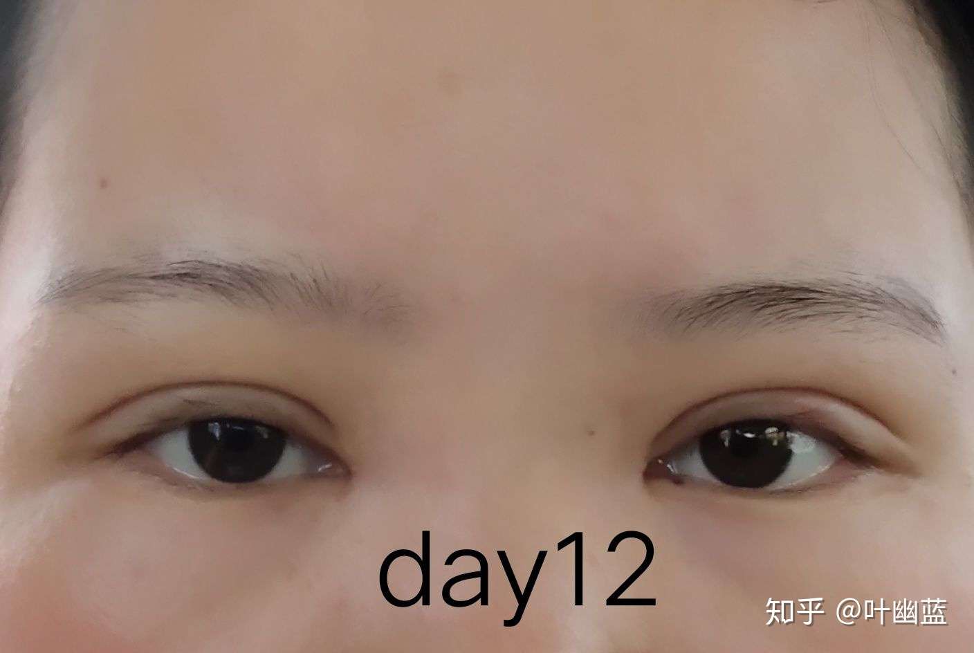 肿眼泡千万别去割双眼皮 不过是换了一种丑法 15个半月啦 知乎