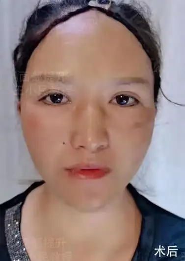 拉皮除皱王小民教授小拉皮手术助你成为冻龄女神