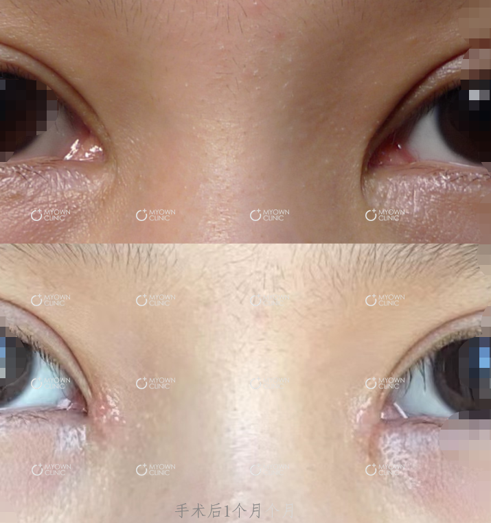 杨东运医生 的想法: 包眼角术后一个月 - 知乎