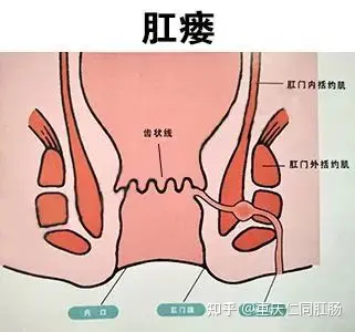 重庆有哪些好的肛肠医院肛门口长包还流脓水是怎么回事