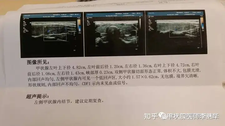 中医解读甲状腺结节、甲亢、甲减，弄懂这些，治疗起来事半功倍（甲状腺结节的中医辩证论治好大夫）