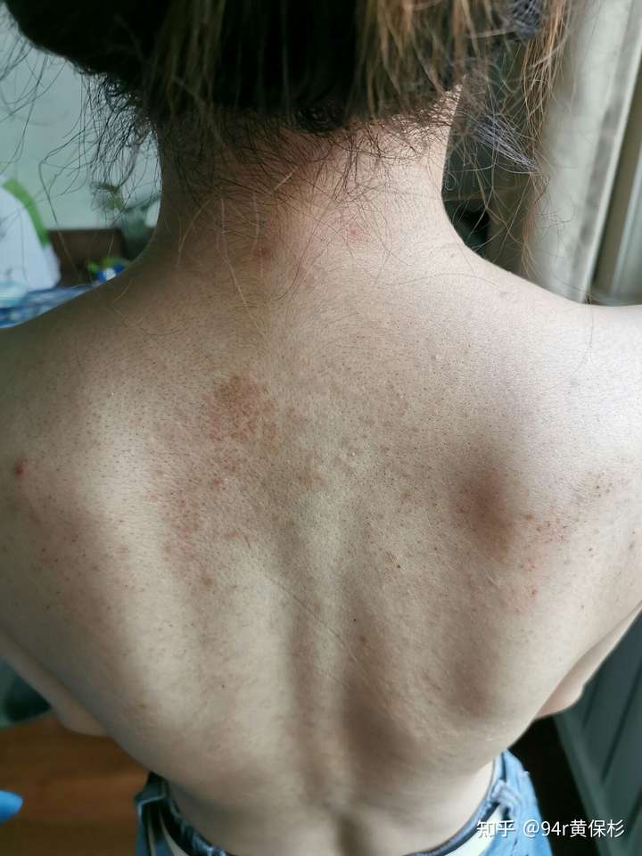 你见过哪些特顽固的毛囊炎?